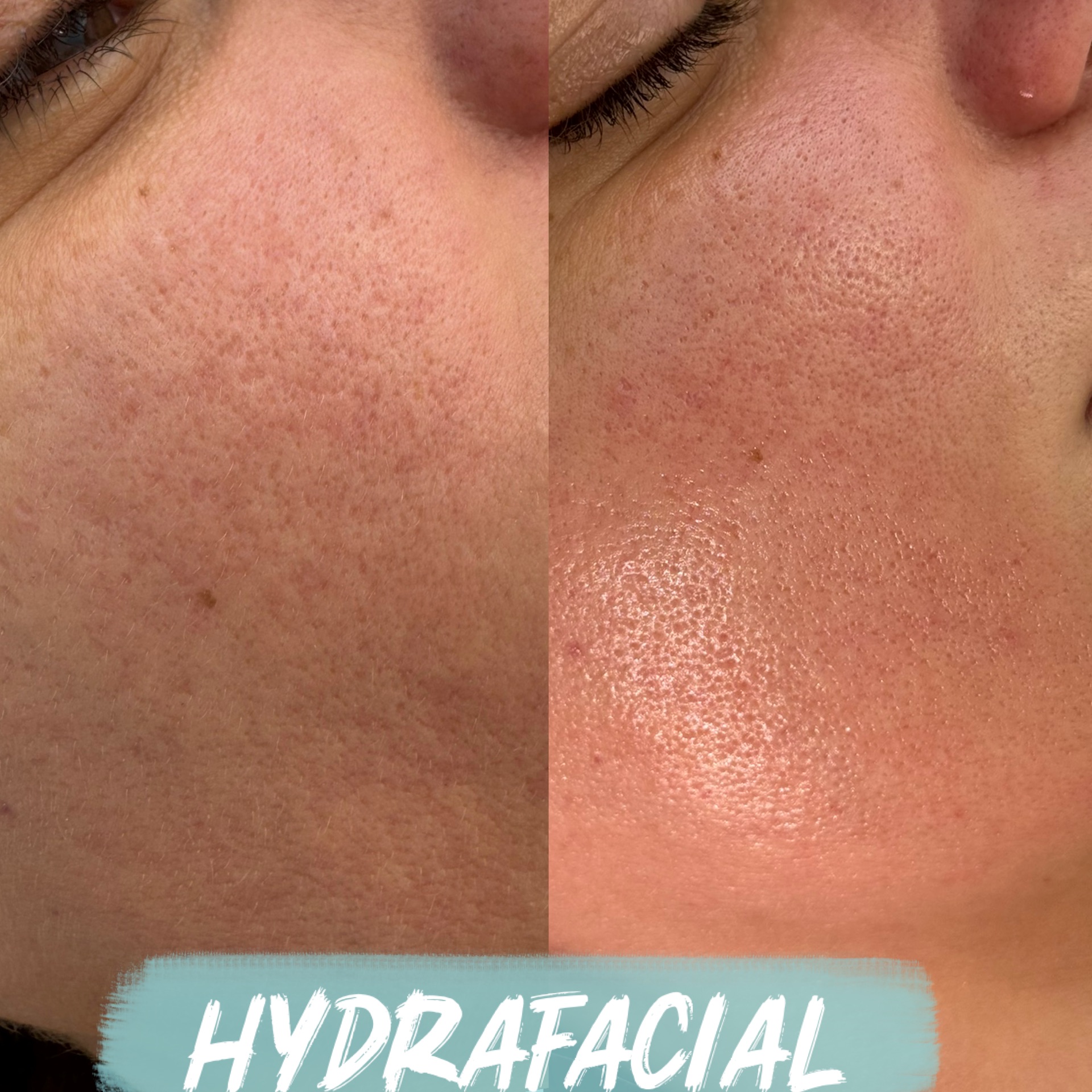 hydrafacial rezultate 2